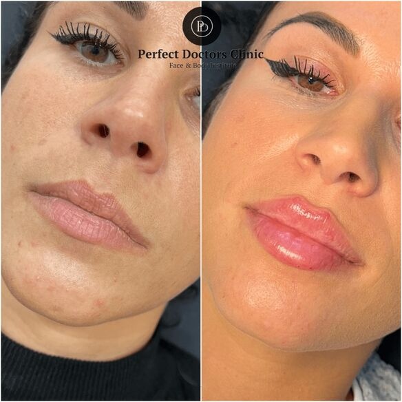 Juvederm Cost Insights by Best Doctors in dubai