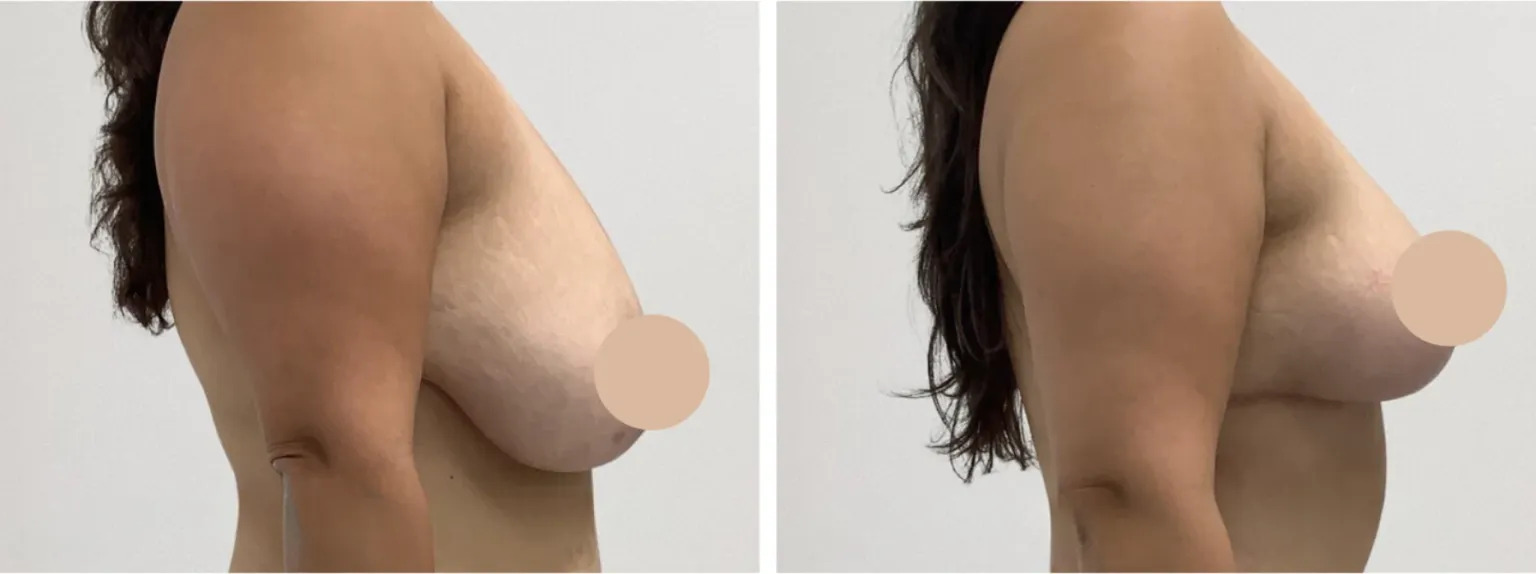 Personalized Breast Lift in Dubai for Balanced Proportions