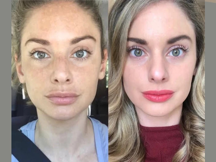 Next-Generation Radiofrequency (RF) Microneedling Treatment in Dubai