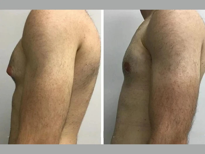 Transform Your Look with Gynecomastia Surgery in Dubai