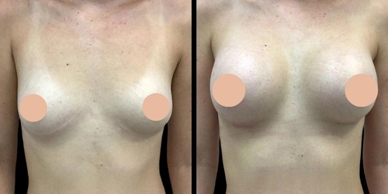 Breast Augmentation in Dubai: Understanding Recovery and Aftercare Tips